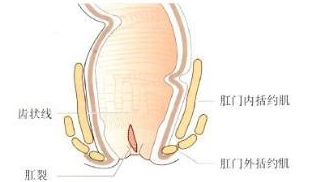 福州肛裂要怎么治疗较好?
