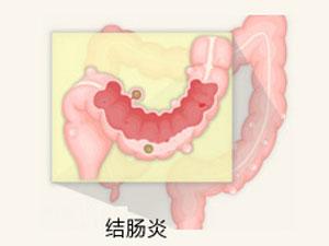 福州结肠炎的治疗费用是多少?