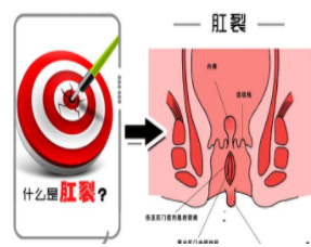 福州肛裂去医院要花多少钱?